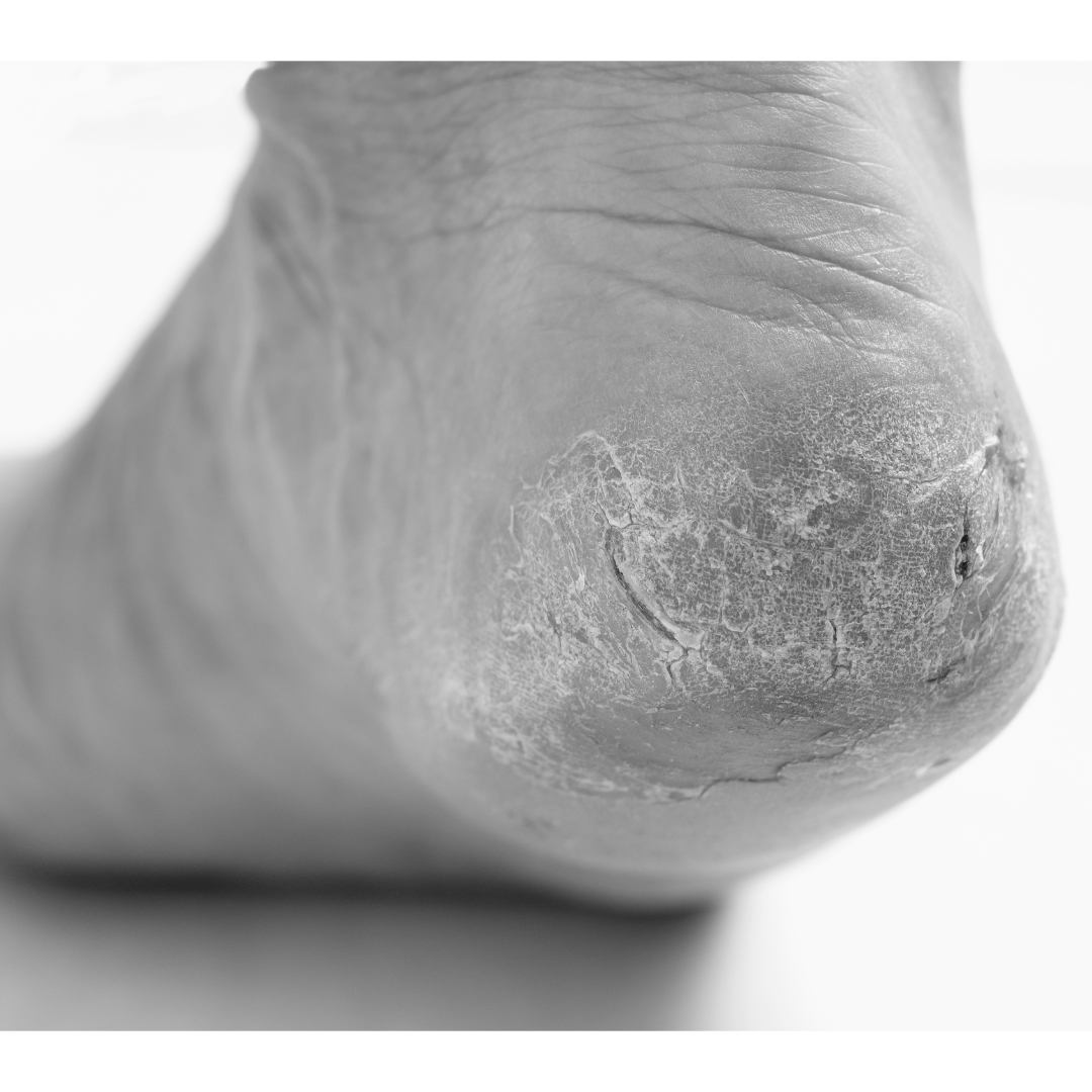 Close-up of cracked heel β ArniCura provides natural Arnica comfort
