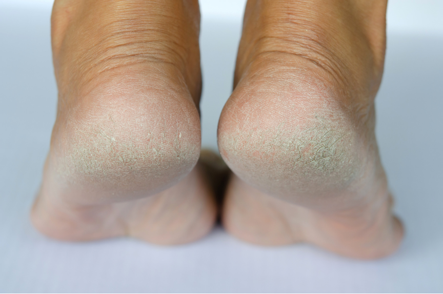 Dry cracked heels close-up β common foot condition that ArniCura helps soothe and moisturize